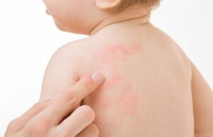 Understanding Childhood Rashes: Causes, Treatments, and When to Seek Help